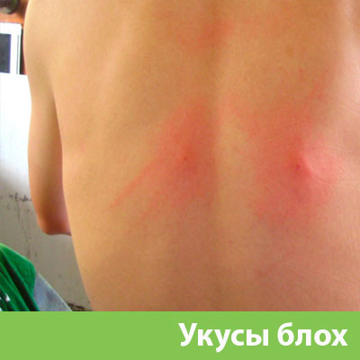 Укусы блох в Красноярске