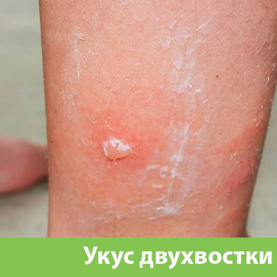Укус двухвостки в Красноярске