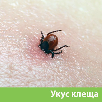 Укус клеща в Красноярске