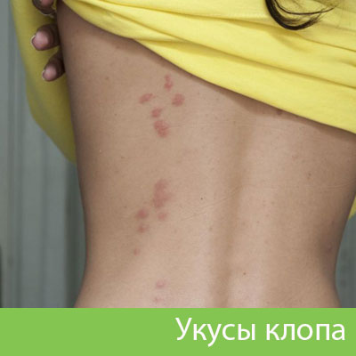 Профессиональное уничтожение клопов в Красноярске